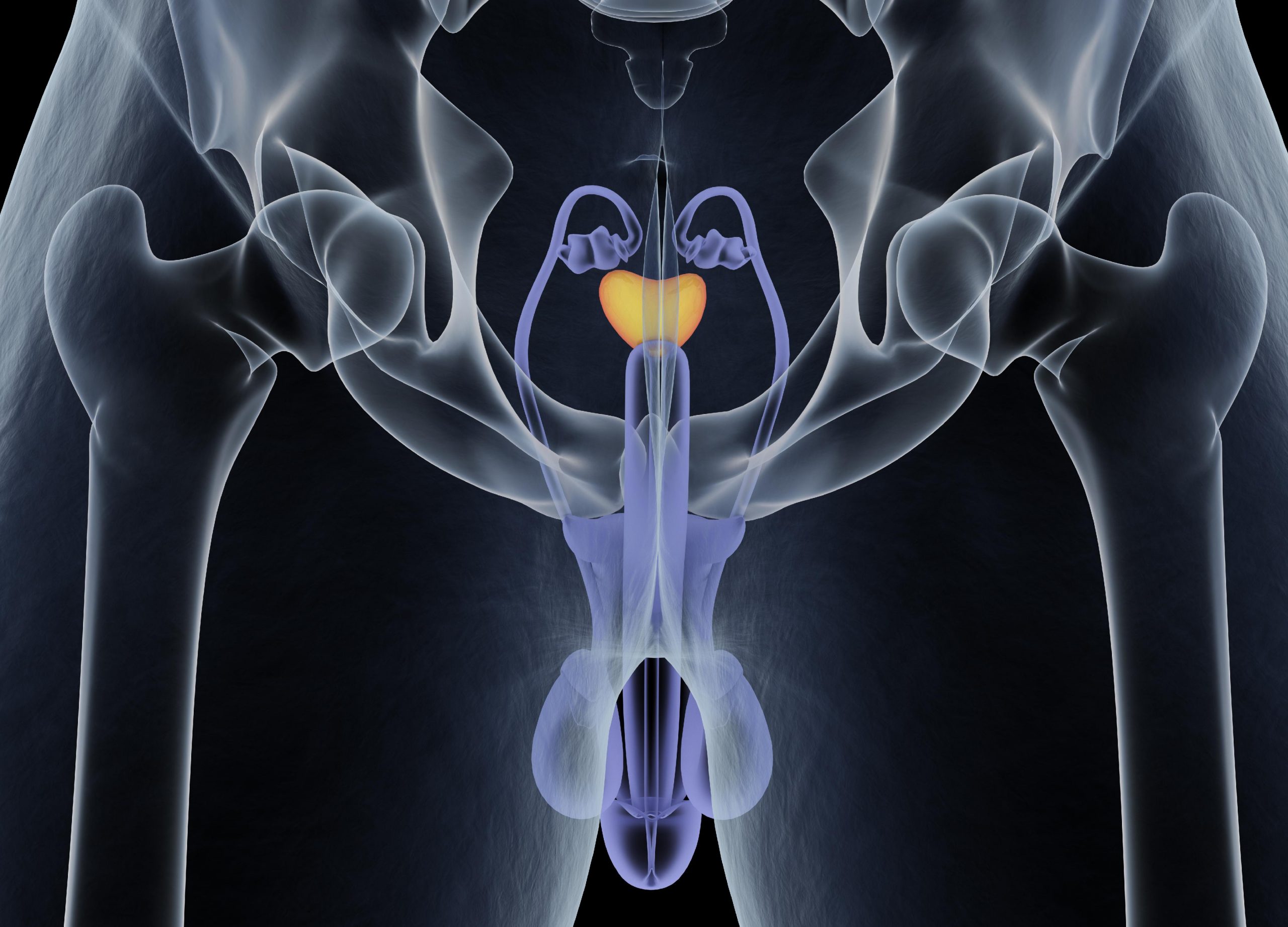Disfuncția erectilă post prostatectomie radicală